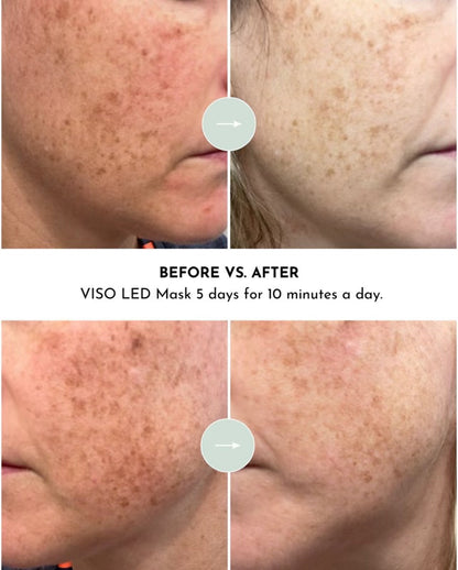 VISO - Anti-Aging Red Light Mask